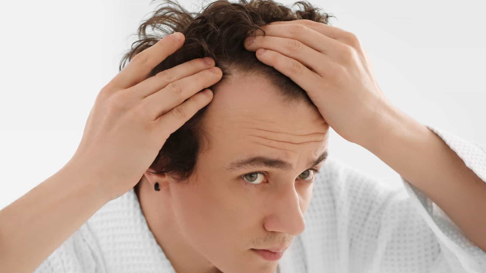 Male Pattern Baldness