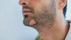 Alopecia Areata Treatment