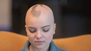 Alopecia Areata Treatment