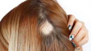 Alopecia Areata Treatment