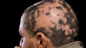 Scarring Alopecia