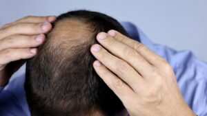 treatment of Telogen Effluvium