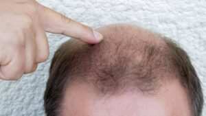 Understanding Telogen Effluvium