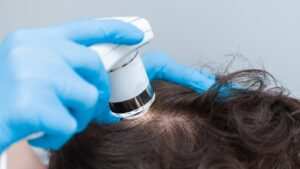 treatment of Telogen Effluvium