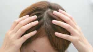 Conditions Treatable with Ketoconazole
