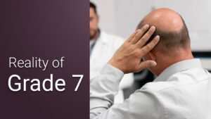 grade 7 hair transplant