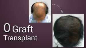 hair transplant