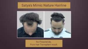 hair transplant