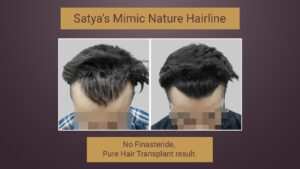 hair transplant