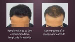 repair hair transplant