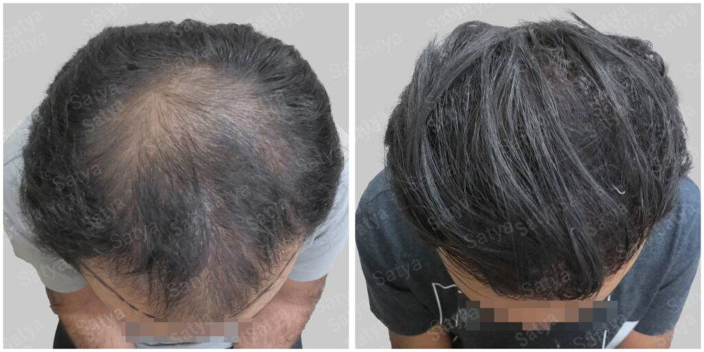 men hair line - Satya hair solutions