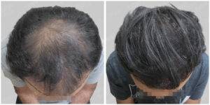 men hair line - Satya hair solutions