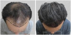 men hair line - Satya hair solutions