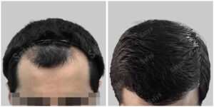 repair hair transplant