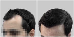 repair hair transplant