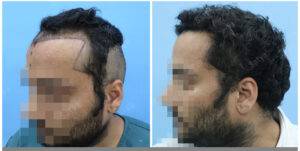 hair transplant results before and after