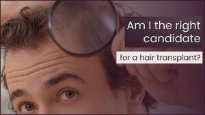 Finding the Perfect Age: Determining the Right Time for a Hair Transplant