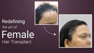 female hair transplant