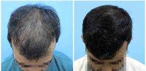 hair transplant before and after