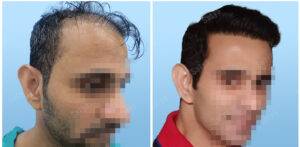 hair transplant before and after