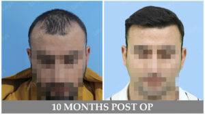 hair transplant results before and after