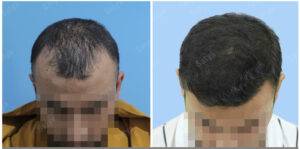 hair transplant results before and after