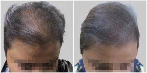 Hair Transplant Before and After Results | Satya hair Solutions