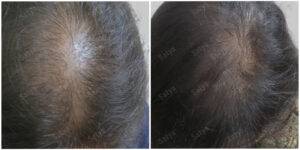 GUNJAN Female Hair Transplant | Women Hair Transplant Cost in India