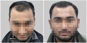 adtiya hair transplant results before and after