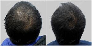 ashish hair transplant results before and after