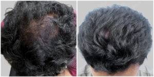Atul before and after hair transplant results