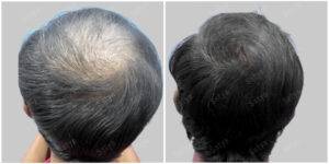 divyansh hair transplant results before and after