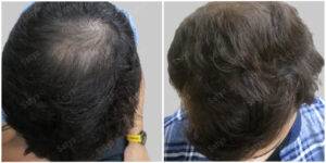 gaurav before and after hair transplant results