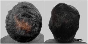 hemant hair transplant results before and after