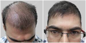 jaswant hair transplant results before and after