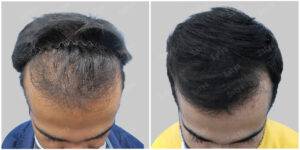kunal hair transplant results before and after