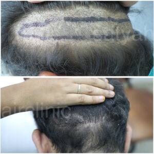 collage scar
