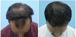 hair transplant results before and after