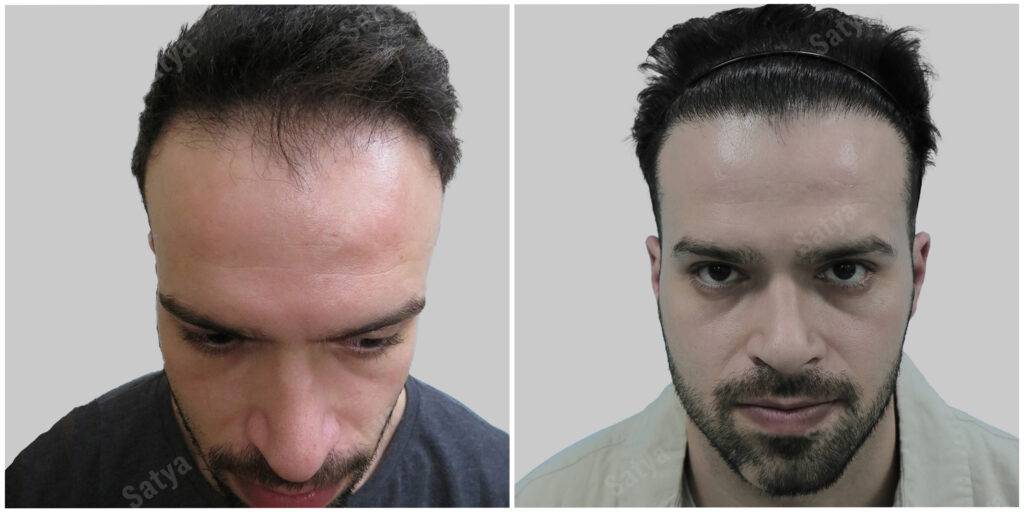 fue hair transplant