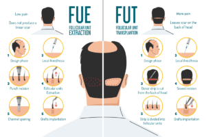 Difference Between FUT & FUE Hair Transplant