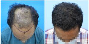 hair transplant results before and after
