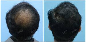 hair transplant results before and after