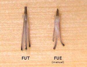 Difference Between FUT & FUE Hair Transplant
