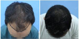 hair transplant results before and after