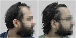 fue hair transplant