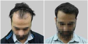 hair transplant before and after