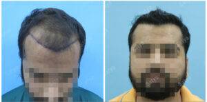 hair transplant before after results