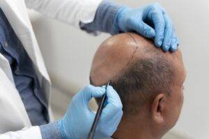 Scalp Micropigmentation treatment