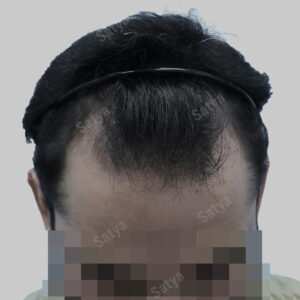 fue hair transplant