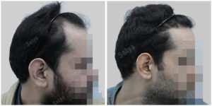 fue hair transplant